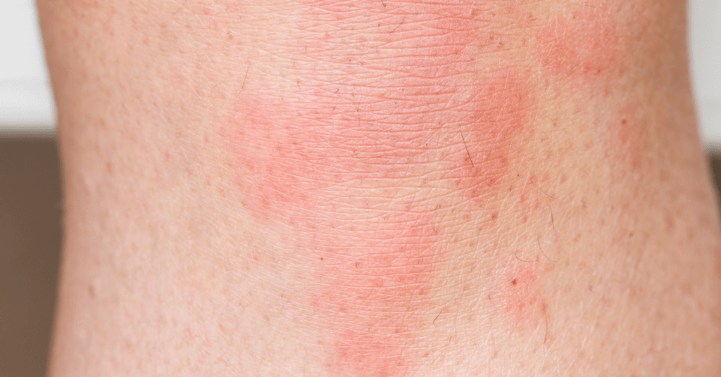 Stress hives pictures symptoms stress rash or not