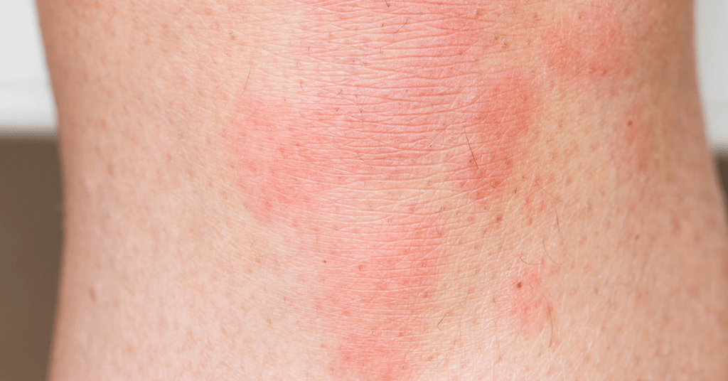 Urticaria por estrés: imágenes, síntomas, ¿sarpullido por estrés o no?