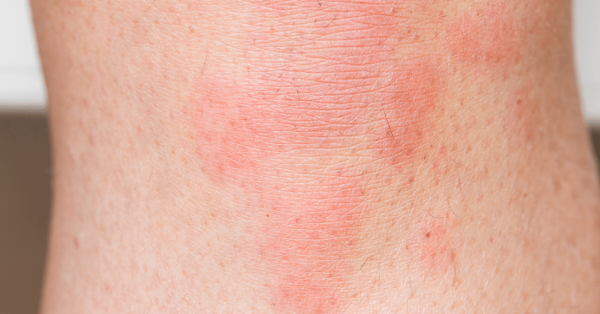 Stress Hives Pictures & Symptoms Stress Rash Or Not