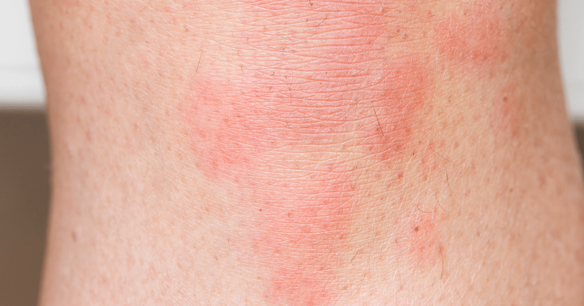 Urticaria por estrés: imágenes, síntomas, ¿sarpullido por estrés o no?