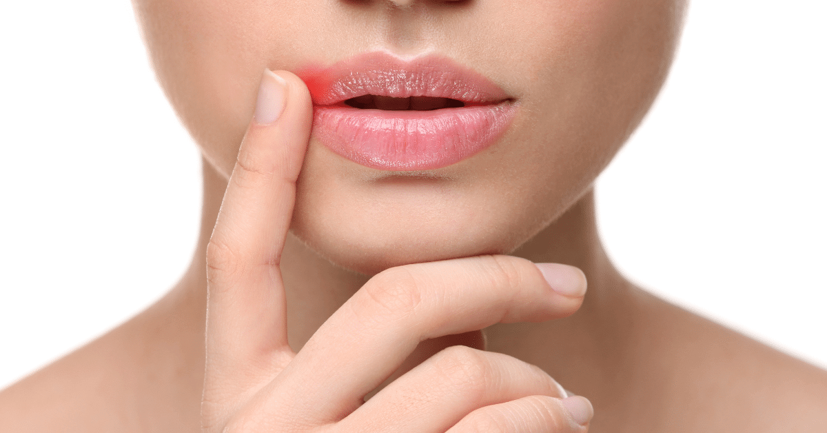 Can Stress Cause Cold Sores